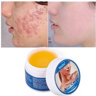 Acne REMOVER CREAM anti-acne acne CREAM acne treatment acne REMOVER prevent acne production acne CRE