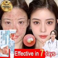 Acne Scar Removal Cream