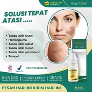 Penghilang Tanda Lahir Oles Tanda Lahir Hemangioma Tanda Lahir Tanda Lahir Coklat Tanda Lahir Hitam
