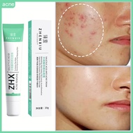 Acne Cream Krim Jerawat Muka Punggung Ubat Jerawat Badan Berkesan Lelaki Dan Wanita Penjagaan Kulit 