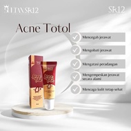 Acne Cream Acne Totol Acne Cream Acne Removal Cream Acne Cleanser Acne Medicine Cream Acne and Black