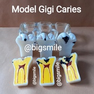 New Model Gigi Implant Bridge Crown Model Gigi Caries Removeable Bisa