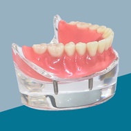 Teeth Model Implants Overdenture Removable Model Dental Implant Model Dental Teaching Model