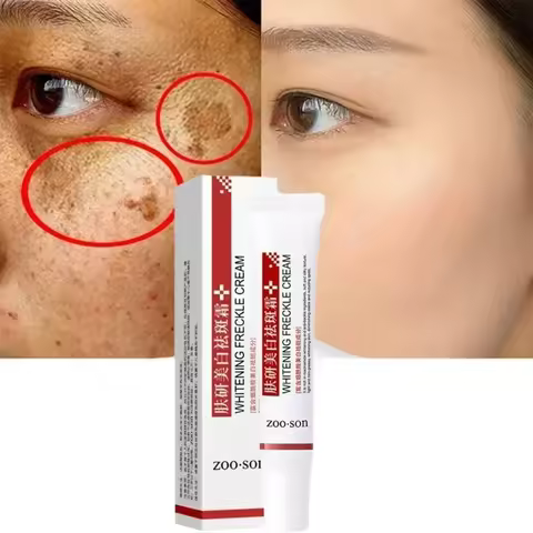 Whitening Freckle Cream Remove Dark Spots Anti Freckle Face Creams Niacinamide Fade Pigmentation Mel