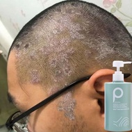 shampoo kelemumur ubat kelemumur kepala syampoo kelemumur anti dandruff dandruff treatment kulit kep
