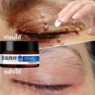 ขี้แมลงวัน หูดตาปลาและติ่งเนื้อ ของแท้ Corns warts removal พร้อมส่ง ไฝ  ครีมแต้มหูด ลอกหูดตาปลา ยาแต้มหูด