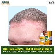 Obat Psoriasis Kulit Psoriasis Lutut Psoriasis Siku Psoriasis Punggung Bagian Bawah Psoriasis Kulit