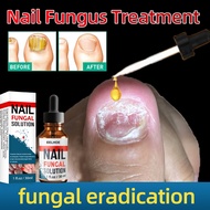 Nail Fungus Treatment Liquid Ubat Kulat Kuku Ubat Kuku Cekam Ubat Kuku Rosak Fungus Nail Repair Esse