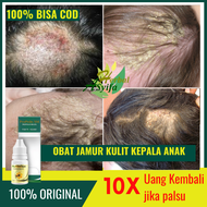 Obat Penghilang Jamur di Kulit Kepala Anak Obat Koreng di Kepala Bayi Cradle Cap Kulit Kepala Bersis