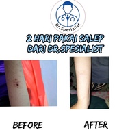 Salep Dermatitis Seboroik dermatitis atopik perioral ampuh