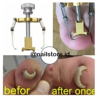 Nail Corrector Tool for Big Toenail Correction Tool toe corrector Ingrown Toenail Corrector Tool / t