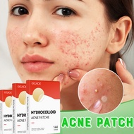 【SG Stock】Acne Patch - Remove Acne Print Remove Acne Scar Treatment serum for acne scar removal