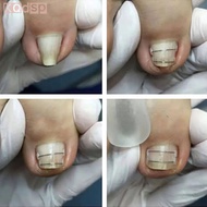 Ingrown Toenail Corrector < kqdsp >