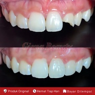 SANGAT KUAT !! PENAMBAL GIGI OMPONG PERMANEN ORIGINAL Gigi palsu penutup ompong asli permanen Penutu