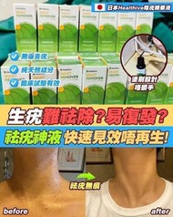 現貨💕日本Healthive除疣無印非藥性精華液💕#醫師推介 #去疣神液！#一塗去疣去雞眼老繭