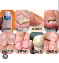 灰甲症狀 指甲變色 甲板變厚 指甲變粉 甲板脫落 凹凸不平 指甲易碎 中空分層 甲板萎縮  有效擊退 成份與羅霉樂一樣 詳情請pm查詢
