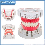 Dental Implant Model Upper/Lower Dental Removable Implant Model with 4 Implants Screws Dental Teachi