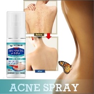 back acne spot treatment acne Spray 60ml  祛痘 祛痘印 body acne you acne plus spot care skintific acne