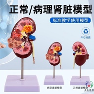 Human Kidney Anatomy Model Disease Change Kidney Model Kidney Model Human Internal Organ Anatomy Mod