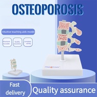 【Fast Shipping】Human Skeleton Osteoporosis Lesion Model Spine Cervical Anatomy Model Joint Model Ske