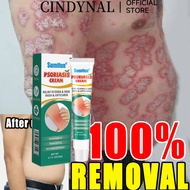 2024 CINDYNAL RIGINAL  Effective Eczema Treatment herbal antibacterial cream 20g Safe and no side ef