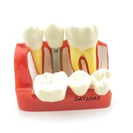 Implant Consulting Jaw Model, Dental Jaw Model, Dental Practice Jaw Model