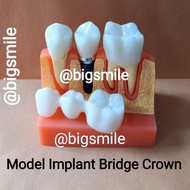 Model Gigi Implant Bridge Crown Model Gigi Caries Removeable Bisa