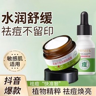 祛痘膏 面部闭口 粉刺 淡化痘印 祛痘霜 Facial acne acne scars acne cream