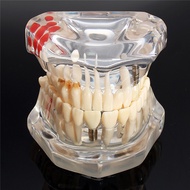 Removable Teeth Model Implant Disease Dentist Studying New Dental Model Teeth Implant Restoration Br