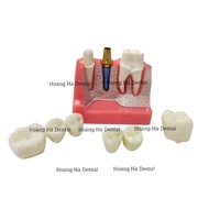 Comparison model of 2 implant methods - dental bridge model for implant consultation