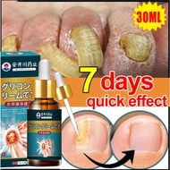 Nail Repair Essence Inhibit Fungal Nail Fungal Treatment Nail fungus