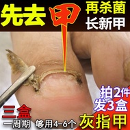 福美宜生灰指甲中草药增厚灰指甲脱甲液专用抑菌液软甲膏甲沟灰指甲液 灰指甲专用套盒