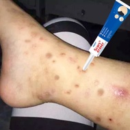 Krim hilangkan parut hitam Hilangkan parut kaki Mosquito bite scar Parut jerawat hitam Bekas kudis O