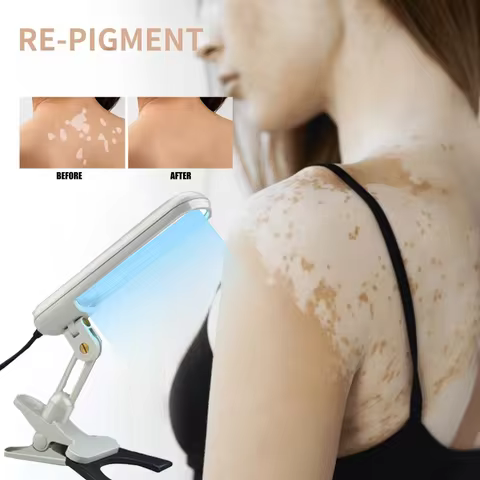 Treatment of Vitiligo Psoriasis with 311 Nm Narrow-Band Ultraviolet Light by UVB Phototherapy Instru