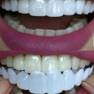 Terjangkau Ideal Smile Gigi Palsu Atas Bawah Gigi Palsu Instan Lepas