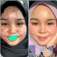 Krim Scar acne treatment