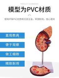 Lifelike Kidney Model with Adrenal Gland Attached Diseased Kidney Model Enlarged Anatomical Model Ed