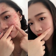 Closed Acne Acne Acne Cream Herbal Acne Removal Cream Acne Removal Cream Men Women Reduce Acne Marks