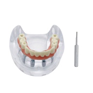 Dental Implant Model Teeth Model 6 Implant Overdenture Restoration Teeth Model Dentist Student Educa