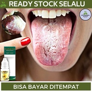 Obat Lidah Putih Obat Lidah Berjamur Obat Lidah Pecah Pecah Obat Lidah Luka Obat Lidah Mati Rasa Ob