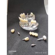 Implant demo model (upper)