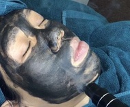 炭粉激光療程  - 面部： - 改善毛孔粗大、黑頭粉刺 - 有效改善暗瘡、平衡油脂分泌 - 消除暗啞、回復光澤、緊緻嫩膚 - 刺激膠原蛋白、活化肌膚細胞再生 背部： - 美白去印、均勻膚色 - 改善毛