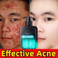 Men's Facial Cleanser Acne Facial Cleanser Remove Mites Acne Blackheads Acne Facial Cleanser 150g 男士