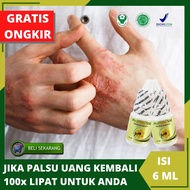 Obat Eksim Eksim Kering Eksim Basah Alergi Alergi Kulit Gatal Ruam Kulit Eksim Statis Kulit Basah Ku