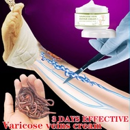 Varicose Vein Cream Effective Anti Varicose Veins Ointment Varicose Veins Treatment Cream 30g Varico