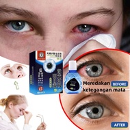 MATA MERAH "Eye Drops Eye Medicine Cataract Cylinder Eye Drops minus Eye Medicine Dry Eye Pain Red Blood Eye Eye Strain"