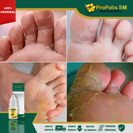 Obat kutu air pada kaki Obat kutu air Obat penghilang kutu air Obat jamur kutu air Obat kutu air pad