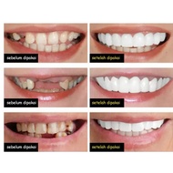 Snap On Smile Gigi Palsu Atas Bawah Pria Wanita Snap on Smile Veneers Gigi Perfect Smile Gigi Tiruan Gigi Palsu Snap On Smile Gigi Palsu 1 Set Atas Bawah - Gigi Palsu Silikon 3101