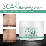 Plant Scar Repair Cream Acne Pit Scar Stretch Mark Remover สำหรับรอยแผลเป็นจากการเผาไหม้เก่าหลังผ่าตัด Removal Skin Smoothing Cream 30G