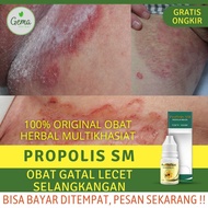 Obat Selangkang Lecet - Obat Selangkangan Gatal Alami Ruam di Selangkanan Selangkangan Berjamur Tine